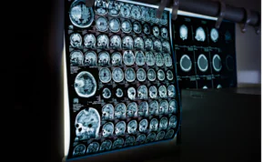 best brain injury lawyer in carbondale il