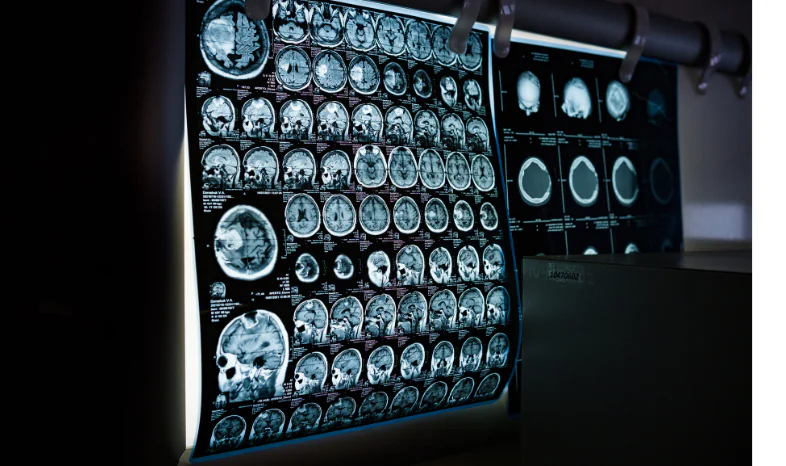 best brain injury lawyer in carbondale il